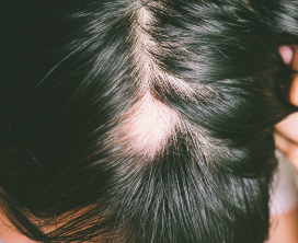 Crown & Bald Spot Coverage