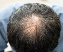 Medical Hair Loss Solutions