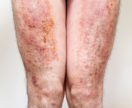 Eczema & Skin Inflammation Management