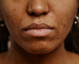 Acne & Scar Improvement