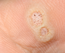 Foot & Plantar Warts Removal