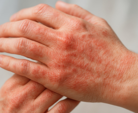 Eczema & Dermatitis Treatment