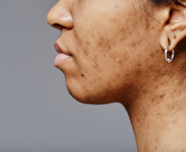 Pigmentation & Dark Spot Correction