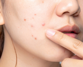 Active Acne Control