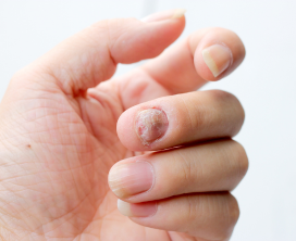 Nail Fungus (Onychomycosis) Treatment