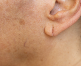 Stretched Ear Lobe Correction