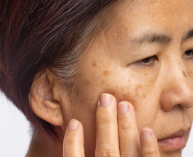 Neck & Cheek Hair Removal