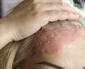 Seborrheic Dermatitis Treatment