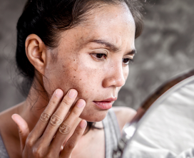 Pigmentation & Dark Spot Removal