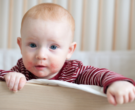 Atopic Dermatitis Treatment