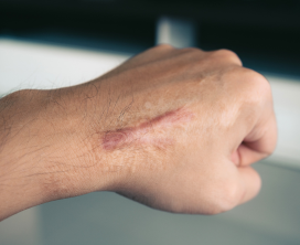 Laser Scar Removal