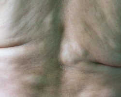 Multiple Lipomas Treatment