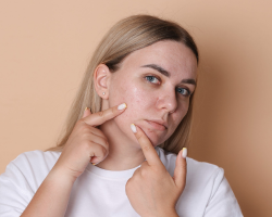 Customized Acne Care Programs