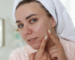 Acne Scar Treatment