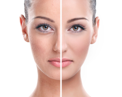 Uneven Skin Tone & Texture Improvement