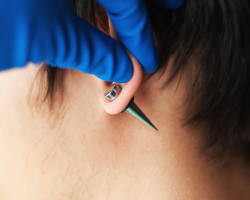 Stretched Ear Lobe Correction