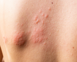 Hives & Urticaria Management