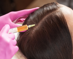 PRP Therapy for Alopecia Areata