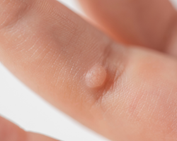 Hand & Finger Warts Removal