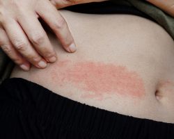 Allergic Skin Rash Treatment