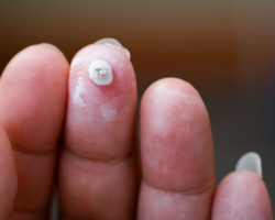 Common Warts Treatment