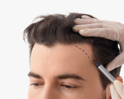Crown & Vertex Area Hair Transplant