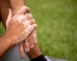  Localized & Generalized Vitiligo Care