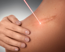  Scar Revision & Transplant Coverage