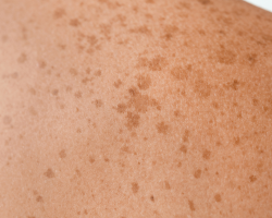 Pigmentation & Dark Spot Removal