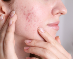 Acne & Acne Scar Reduction Peels