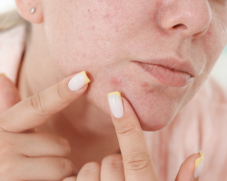 Acne & Scar Treatment