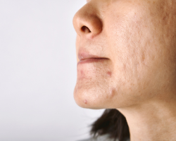 Acne Scar & Pigmentation Correction