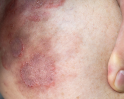 Ringworm (Tinea) Treatment