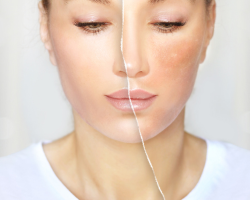 Scar & Spot Lightening Treatments