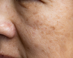 Pigmentation & Dark Mark Reduction