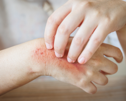 Recurrent Fungal Infection Management