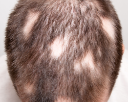 Alopecia Camouflage