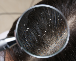 Dandruff & Scalp Care Solutions
