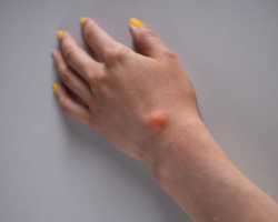 Single Lipoma Removal