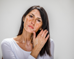 Face & Hand Vitiligo Treatment