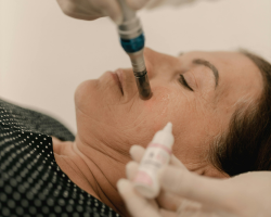 Microdermabrasion for Acne Marks