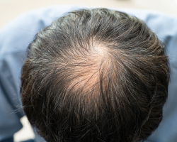 Medical Hair Loss Treatments