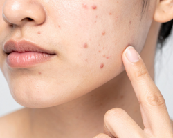 Active Acne Control