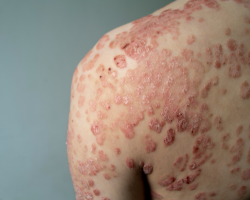 Guttate Psoriasis Treatment