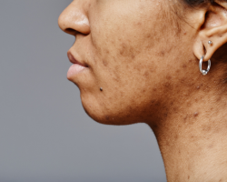 Acne Scar Reduction