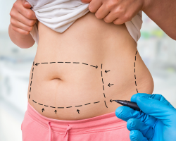 Liposuction Surgery