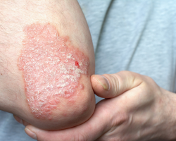 Plaque Psoriasis Treatment