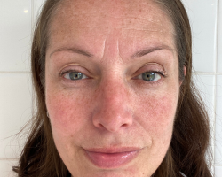  Pigmentation & Sun Damage Correction