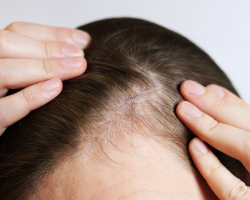 Post-Hair Transplant Density Pigmentation