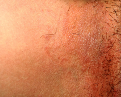 Body & Groin Fungal Infection Treatment